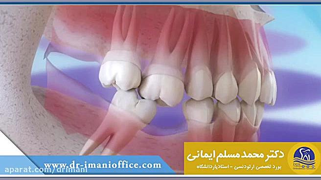 عوارض جای خالی دندان ها بر روی ترتیب دندان ها دکتر محمد مسلم ایمانی - متخصص ارتودنسی در کرمانشاه