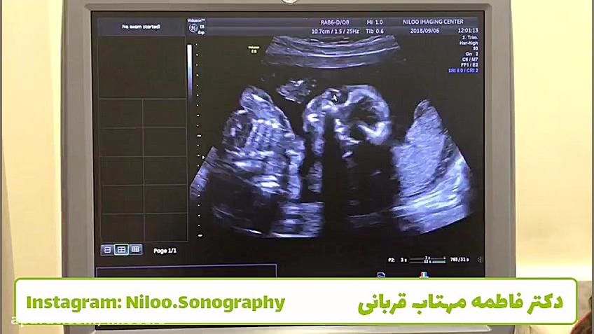 سونوگرافی جنین - آب مروارید مادرزادی سونوگرافی نیلو دکتر فاطمه مهتاب قربانی