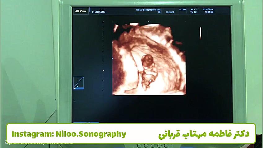 سونوگرافی جنین 10 هفته سونوگرافی نیلو دکتر فاطمه مهتاب قربانی