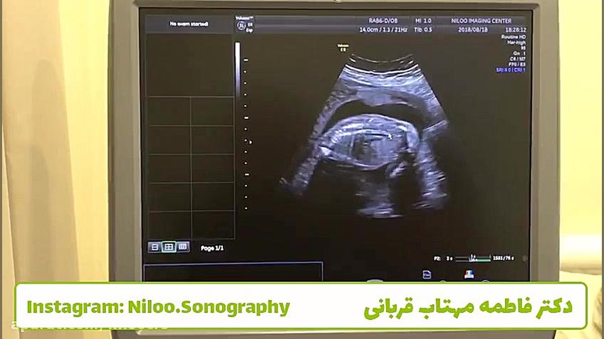 سونوگرافی جنین - ستون فقرات سونوگرافی نیلو دکتر فاطمه مهتاب قربانی