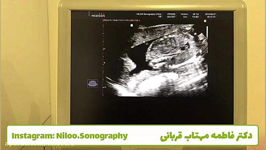 سونوگرافی جنین - قیفی شدن کیسه آب سونوگرافی نیلو دکتر فاطمه مهتاب قربانی