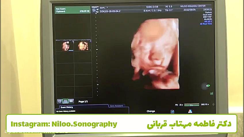 سونوگرافی جنین - تشخیص جنسیت سونوگرافی نیلو دکتر فاطمه مهتاب قربانی