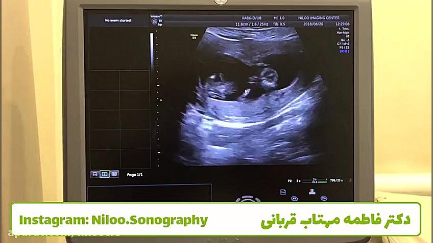 سونوگرافی جنین - کف دست جنین سونوگرافی نیلو دکتر فاطمه مهتاب قربانی