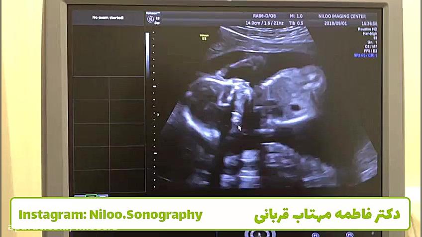 سونوگرافی جنین - توضیح در مورد حرکات جنین قسمت 1 کلینیک لیزر