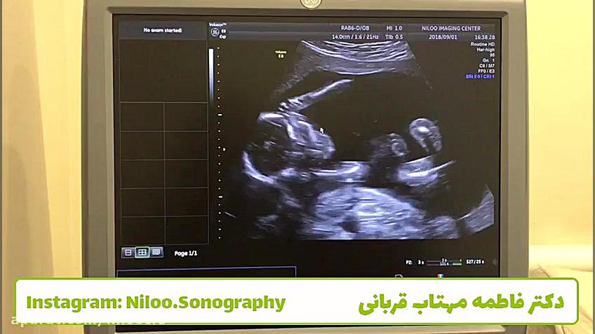 سونوگرافی جنین - توضیح در مورد حرکات جنین قسمت 2 سونوگرافی نیلو دکتر فاطمه مهتاب قربانی