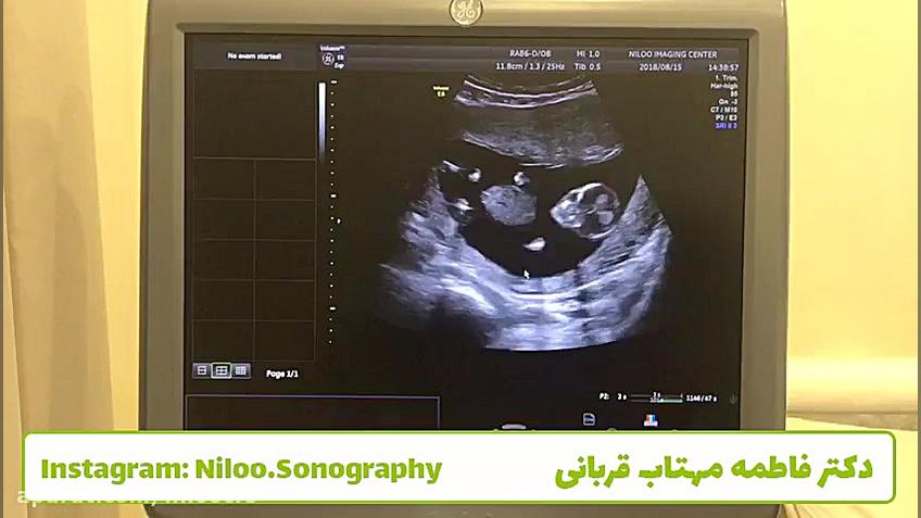 سونوگرافی جنین - قرارگیری صحیح جنین در سونوی NT سونوگرافی نیلو دکتر فاطمه مهتاب قربانی