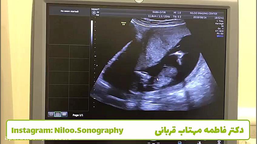 سونوگرافی جنین 13 هفته و غربالگری اول سونوگرافی نیلو دکتر فاطمه مهتاب قربانی