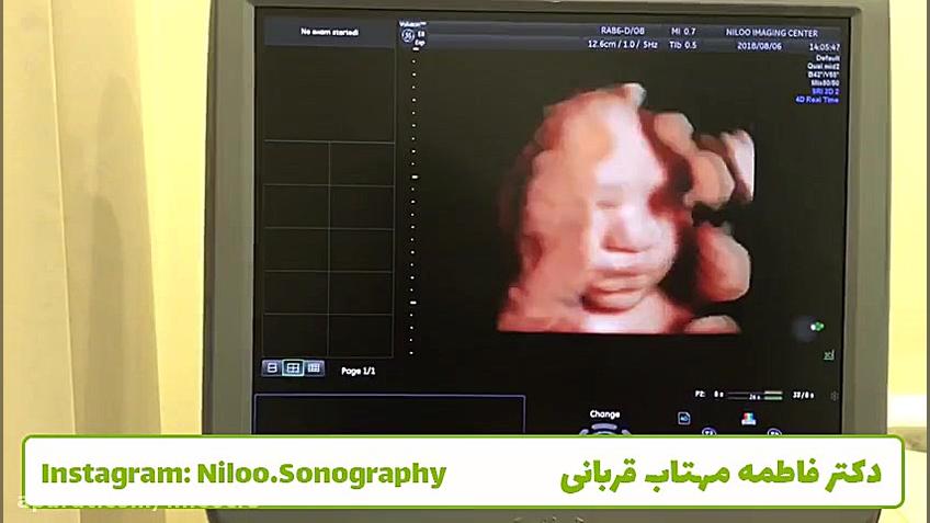 سونوگرافی جنین - بیوفیزیکال سونوگرافی نیلو دکتر فاطمه مهتاب قربانی