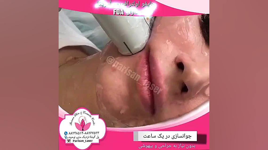 هایفوتراپی/اولترافورمر آمریکا/مرکز زیبایی پری سان پروتز سینه