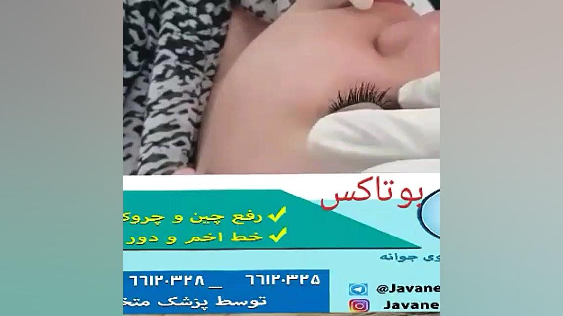 تزریق بوتاکس ریبوسیکلیب