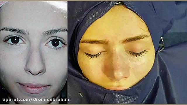 جراحی زیبایی بینی توسط بهترین جراح بینی طبیعی، دکتر امید ابراهیمی دکتر امید ابراهیمی