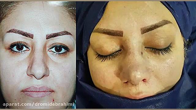جراحی بینی گوشتی توسط بهترین جراح بینی، دکتر امید ابراهیمی دکتر امید ابراهیمی