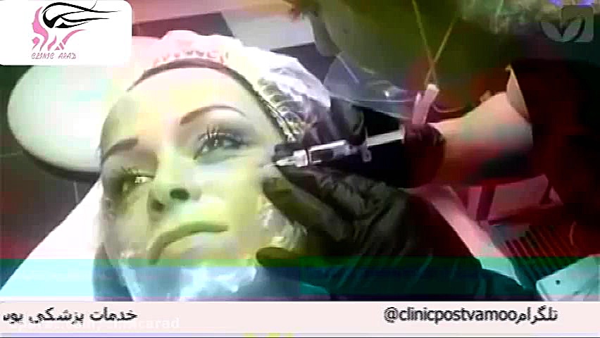 مزوتراپی صورت PEFR