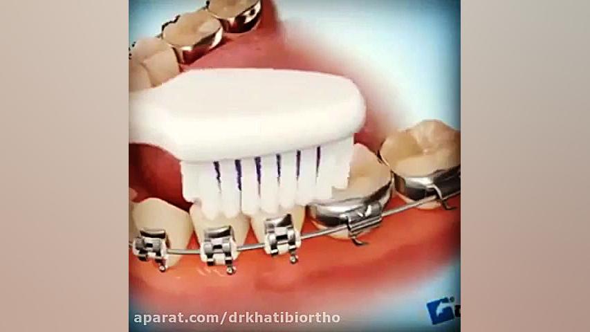 اموزش استفاده از مسواك مخصوص ارتودنسي دکتر امیرحسین خطیبی