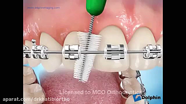اموزش استفاده از مسواك بين دنداني دکتر امیرحسین خطیبی