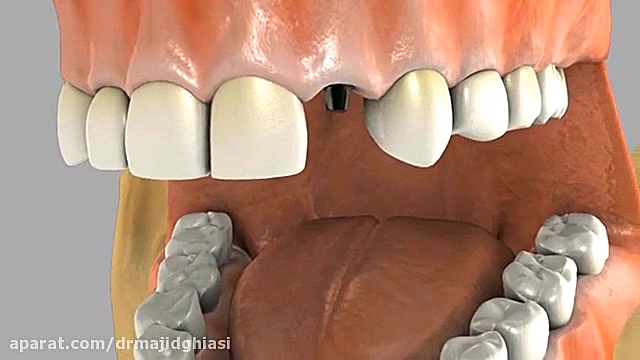 مراحل ایمپلنت دندان -دکترمجیدقیاسی -زراعه الاسنان دکترمجیدقیاسی