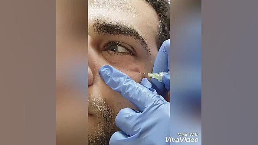 رفع تیرگی دور چشم با کربوکسی تراپی کلونیک اسپاسم