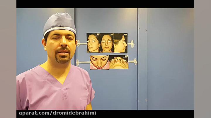 جراحی بینی استخوانی قوز دار توسط دکتر امید ابراهیمی دکتر امید ابراهیمی