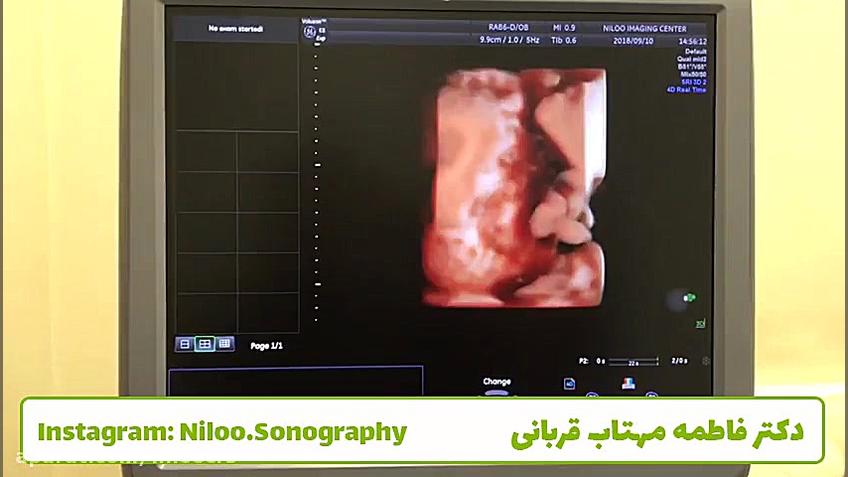 سونوگرافی جنین - بزرگی نرمال سر سونوگرافی نیلو دکتر فاطمه مهتاب قربانی