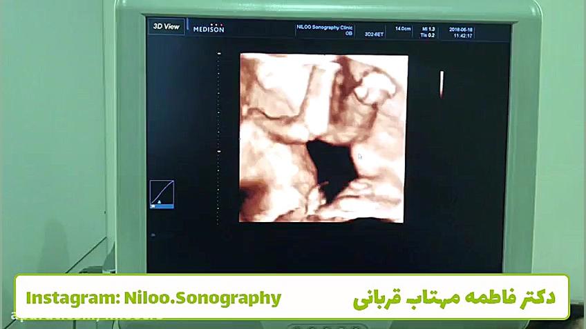 سونوگرافی جنین - پاچنبری سونوگرافی نیلو دکتر فاطمه مهتاب قربانی
