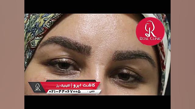 نظرات در مورد کاشت ابرو | فیلم کاشت ابرو | شماره 11 بررسی اروماتاز
