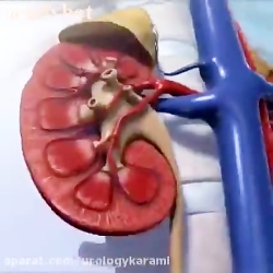 نحوه تشکیل سنگ کلیه و حرکت بسوی حالب و گیر افتادن در ابتدای حالب