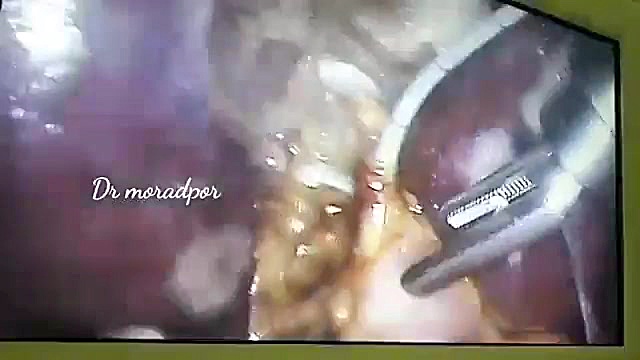 لاپاراسکوپی کولانژیوگرافی(تصویر برداری از مجاری صفراوی)با ۳ پورت توسط دکتر مرادپ آزمون سنجش اسید بیلی‌روبین غیرمستقیم