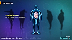 عمل جراحی درمان چاقی حلقه معده
