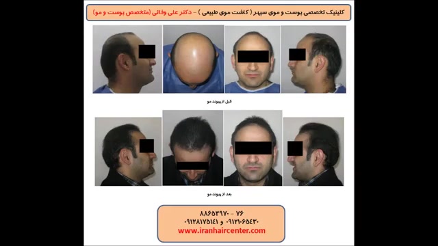 عکس های بیماران دکتر علی وفائی - بخش چهارم دکتر علی وفائی - متخصص پوست و مو