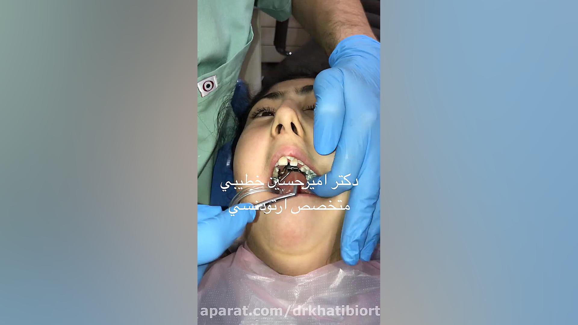 قراردهی دستگاه ارتودنسی هایركس جهت رفع تنگی فك بالا دکتر امیرحسین خطیبی