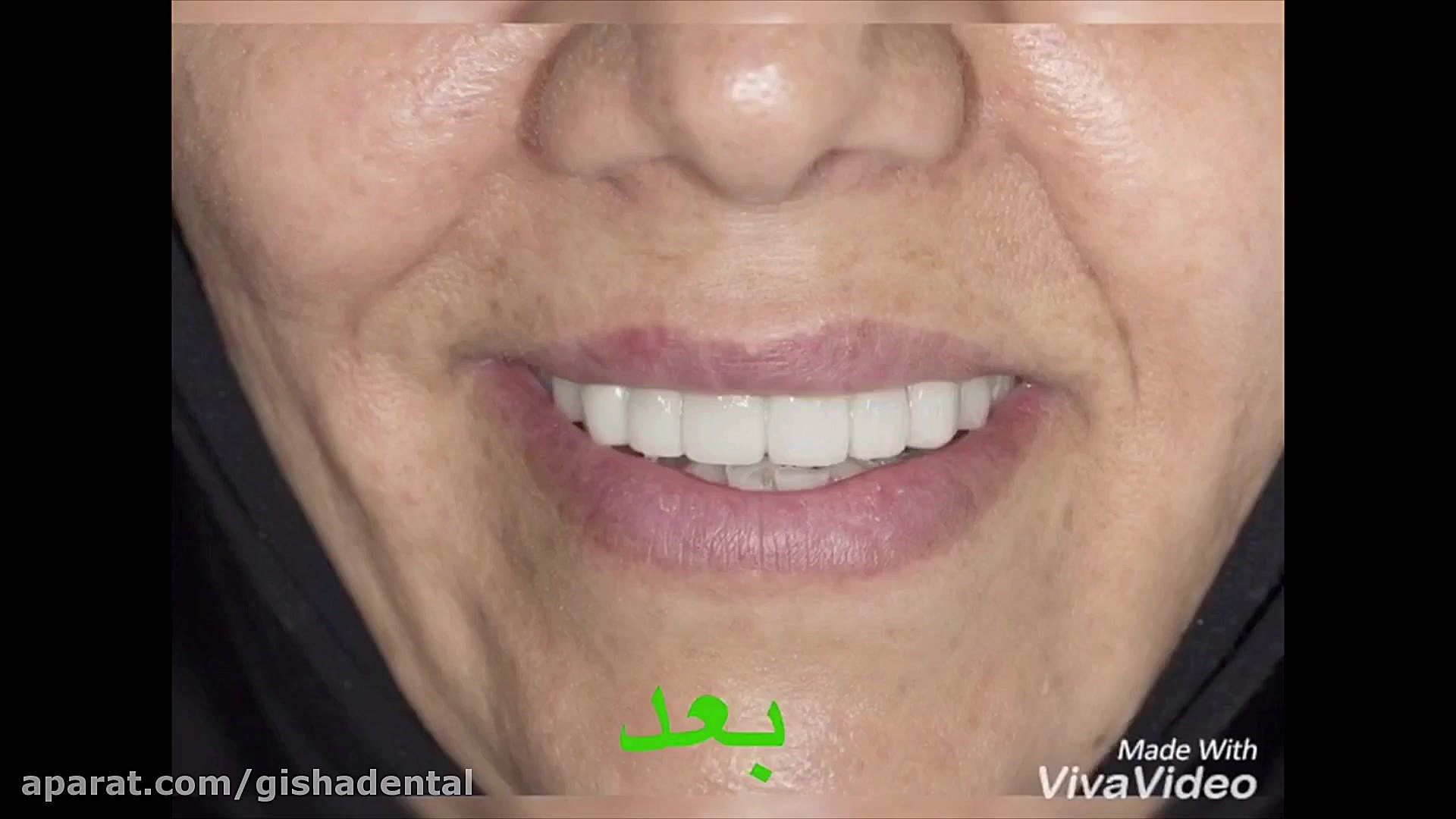 بازسازی دندانها با ایمپلنت و روکش در کلینیک گیشا کلینیک دندانپزشکی دکتر عزیز گشاده رو