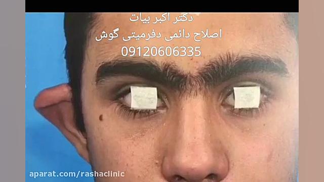 جراحی به منظور بازسازی گوش آزمون سنجش اسید بیلی‌روبین غیرمستقیم