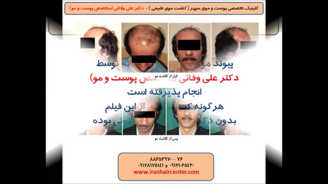 عکس های بیماران دکتر علی وفائی - بخش دوم دکتر علی وفائی - متخصص پوست و مو