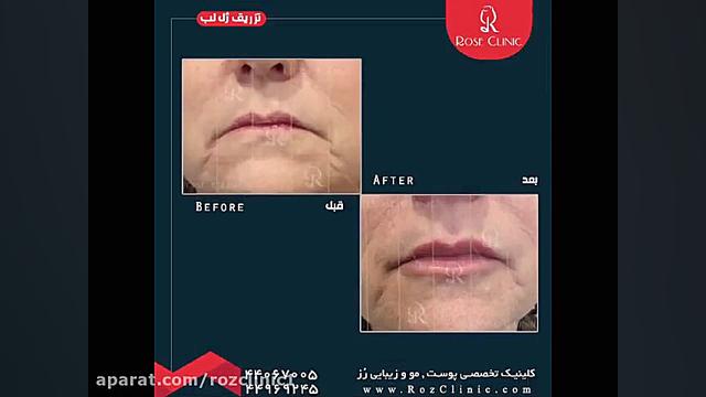 تزریق ژل | تزریق ژل لب | فیلم تزریق ژل لب | کلینیک پوست و مو رز ایمونولوژی محاسباتی
