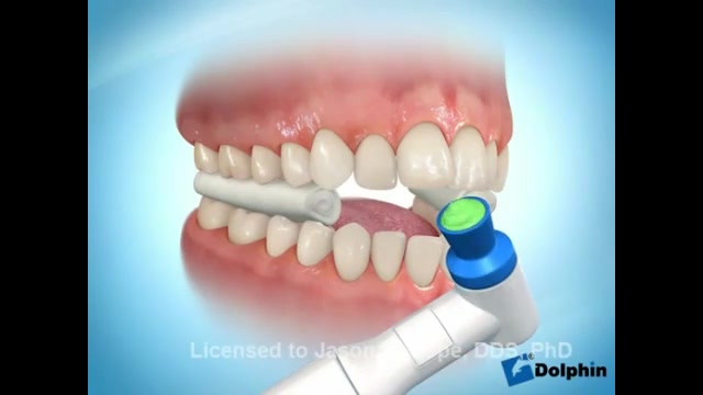 نحوه اتصال براکتهای ارتودنسی به دندانها لیفت ابرو
