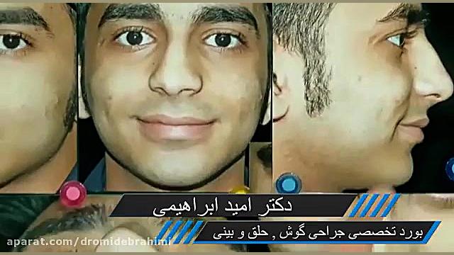 جراحی بینی گوشتی انحرافدار توسط دکتر امید ابراهیمی بهترین جراح بینی دکتر امید ابراهیمی