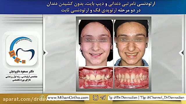 ارتودنسی بدون کشیدن دندان | دکتر داوودیان نپتوکلیب