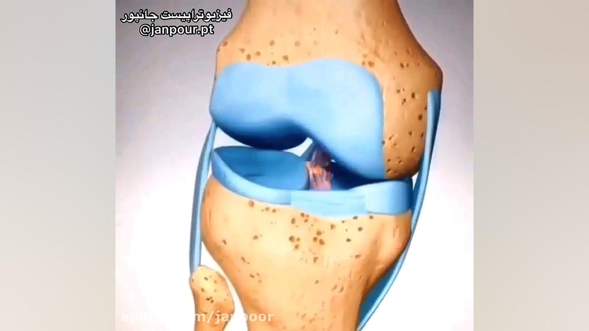 طریقه آسیب رباط صلیبی زانو 09122655648 دکتر فیزیوتراپی،طب فیزیکی و توانبخشی ترمیم زیبایی دندان