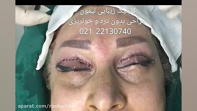 جوانسازی بخش بالای صورت با انجام همزمان سه اقدام جراحی کاشت مو