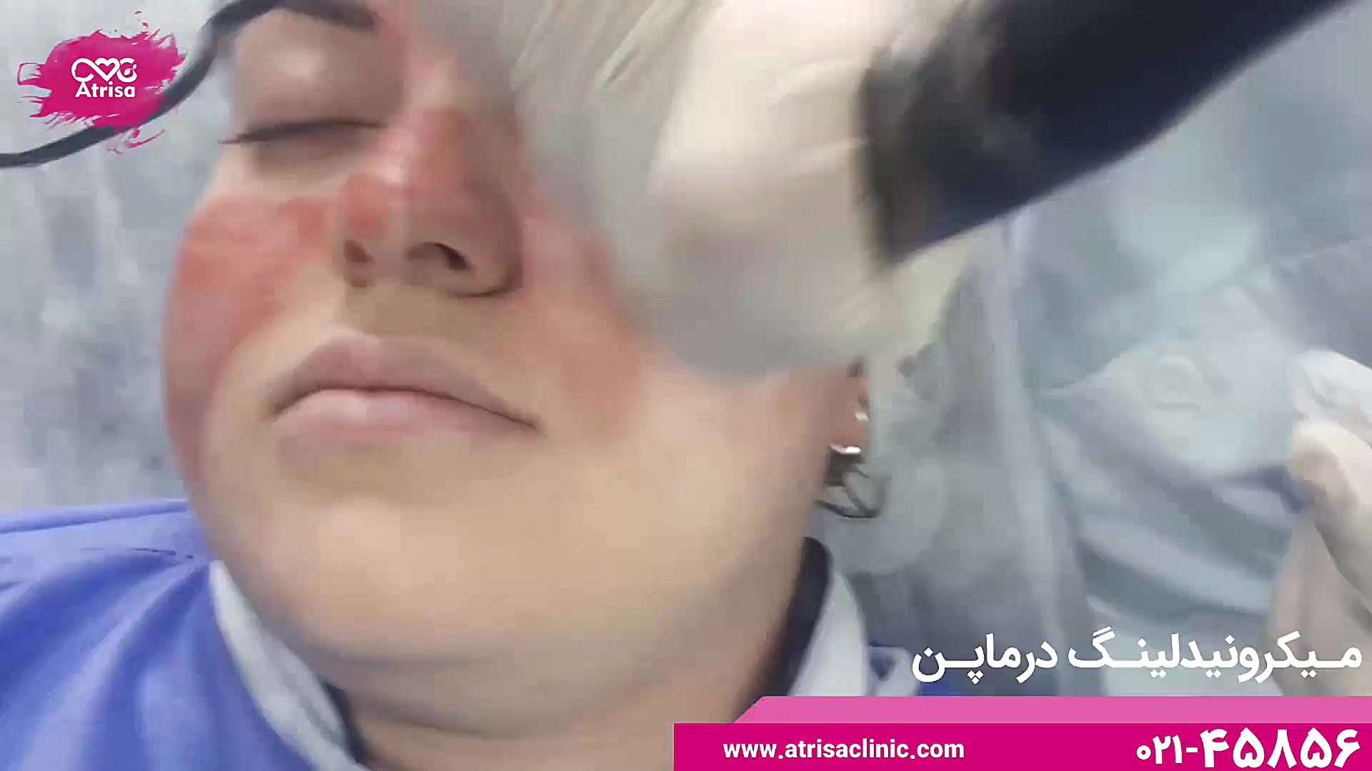 میکرونیدلینگ (دستگاه جوانسازی پوست) کلینیک پوست