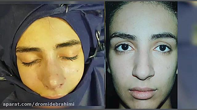 جراحی بینی گوشتی توسط دکتر امید ابراهیمی بهترین جراح بینی دکتر امید ابراهیمی