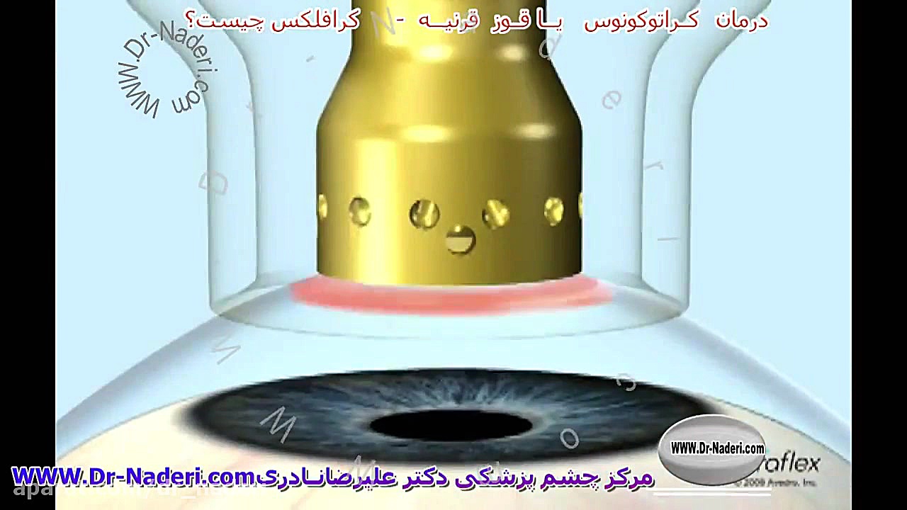 کرافلکس - مرکز چشم پزشکی دکتر علیرضا نادری مرکز چشم پزشکی دکتر علیرضا نادری www.dr-naderi.com