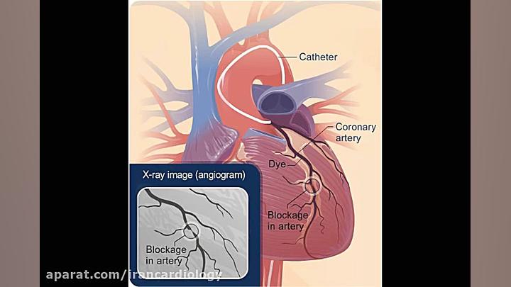 آنژیوگرافی قلب چگونه است؟ تزریق ژل