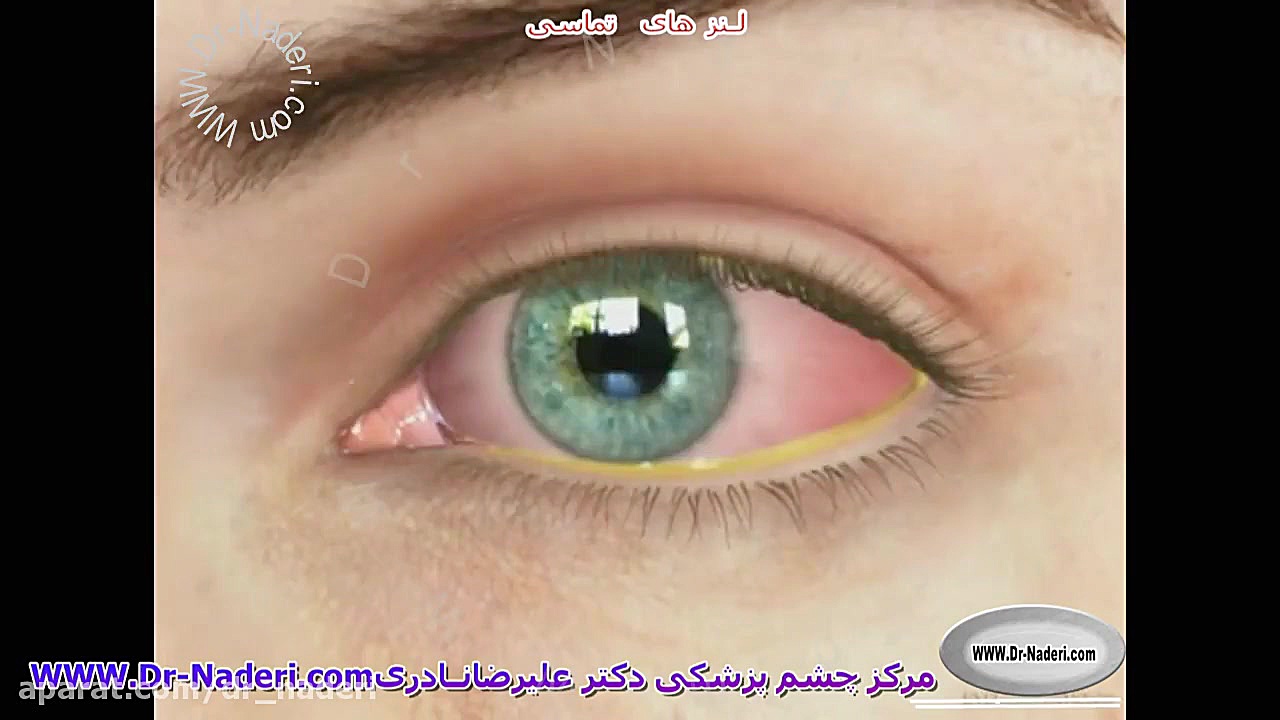 لنز تماسی چیست؟ -مرکز چشم پزشکی دکتر علیرضا نادری مرکز چشم پزشکی دکتر علیرضا نادری www.dr-naderi.com