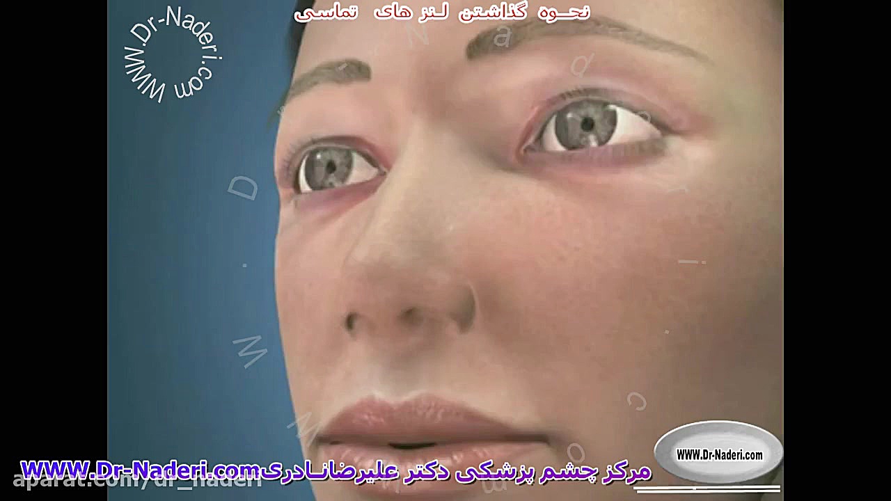 چگونه لنز تماسی نرم را در چشم بگذاریم؟ مرکز چشم پزشکی دکتر علیرضا نادری آنیسکوری