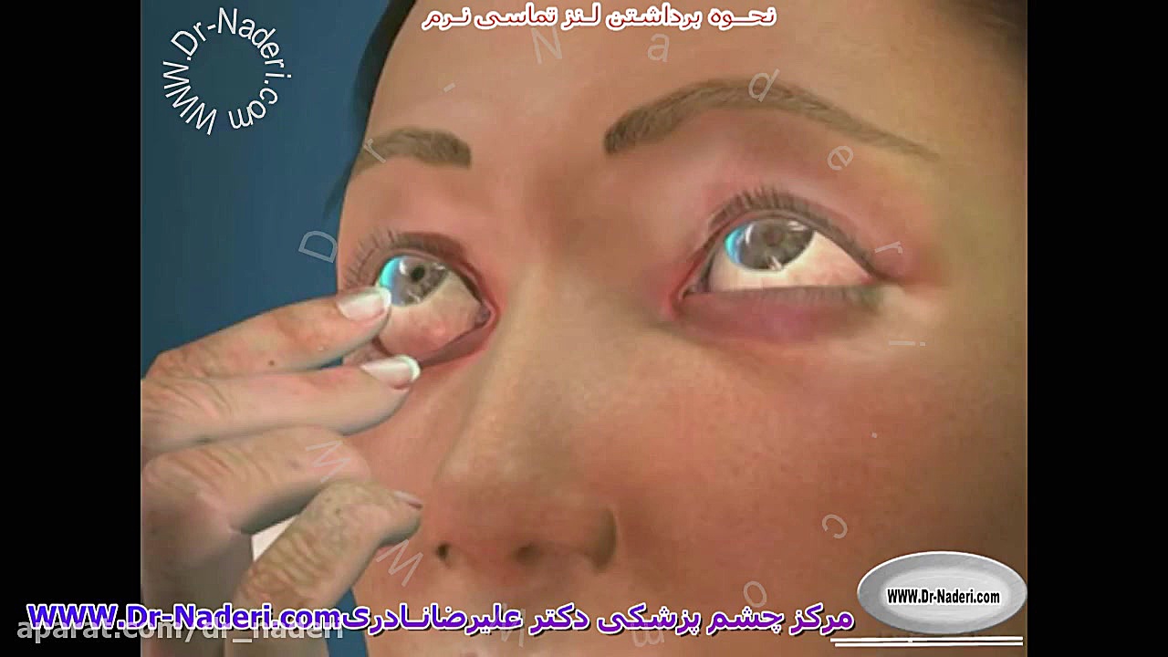 برداشتن لنز تماسی نرم از چشم - مرکز چشم پزشکی دکتر علیرضا نادری مرکز چشم پزشکی دکتر علیرضا نادری www.dr-naderi.com