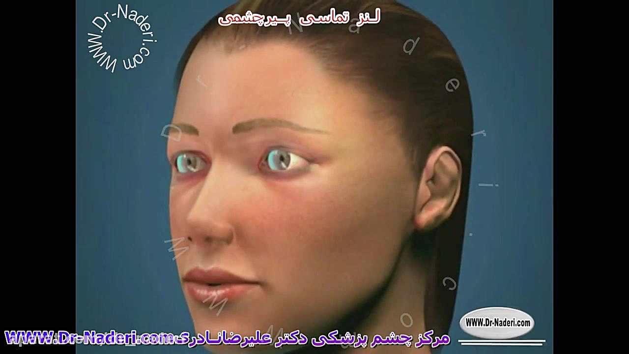 لنزهای تماسی پیرچشمی - مرکز چشم پزشکی دکتر علیرضا نادری مرکز چشم پزشکی دکتر علیرضا نادری www.dr-naderi.com