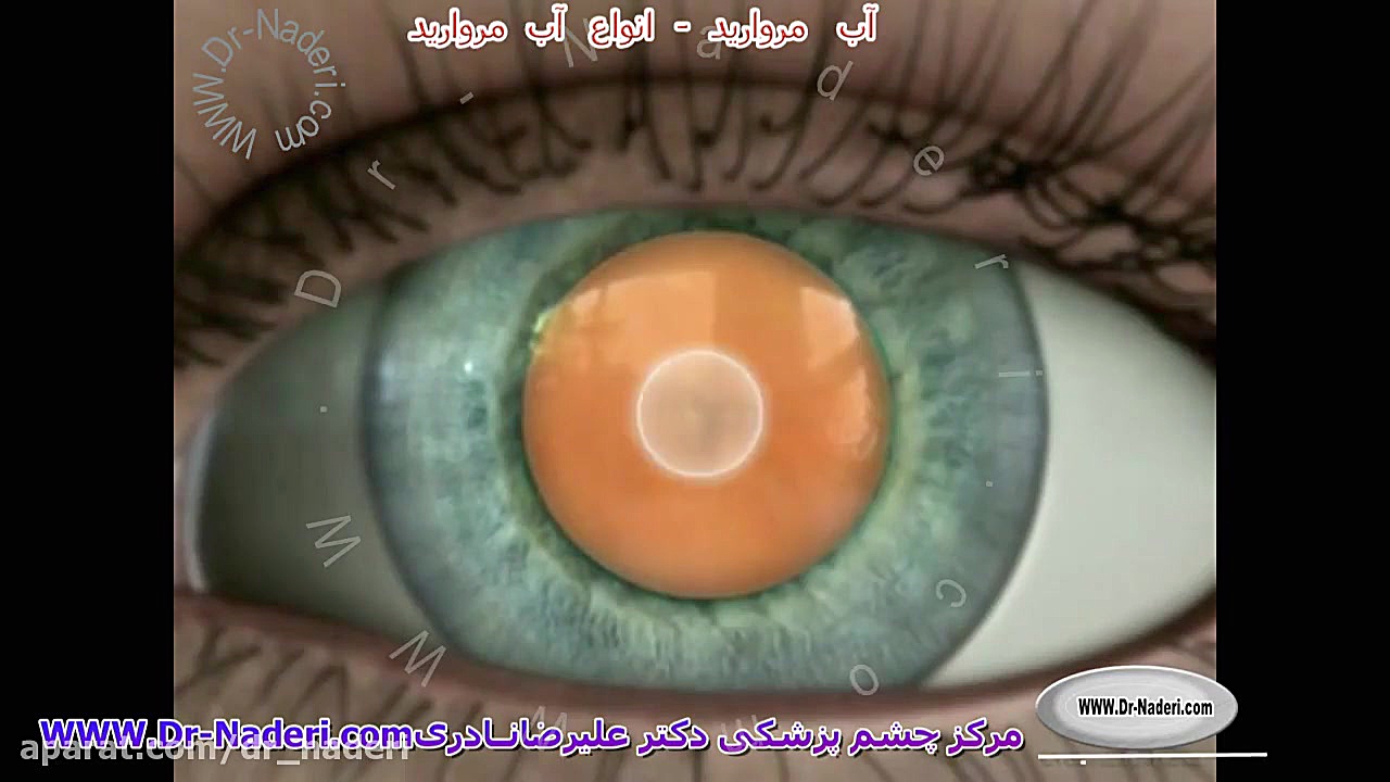 انواع آب مروارید - مرکز چشم پزشکی دکتر علیرضا نادری مرکز چشم پزشکی دکتر علیرضا نادری www.dr-naderi.com