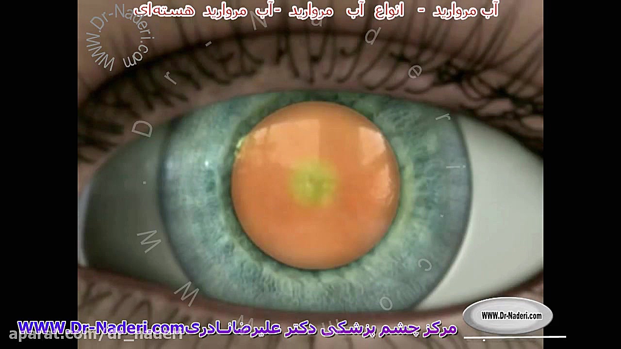 کاتاراکت نوکلئار - سایت چشم پزشکی دکتر علیرضا نادری مرکز چشم پزشکی دکتر علیرضا نادری www.dr-naderi.com