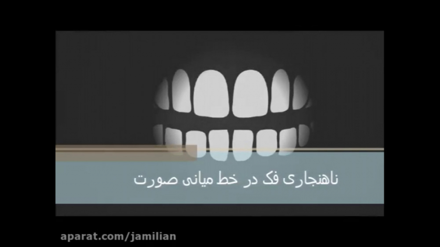 ناهنجاری فک در خط میانی صورت دکتر عبدالرضا جمیلیان - متخصص ارتودنسی